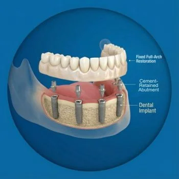 Fixed-Full-Arch-Restoration