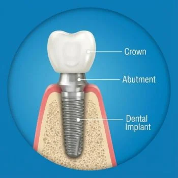 Single-Dental-Implant